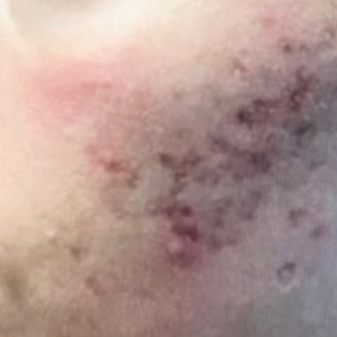 before skinPen