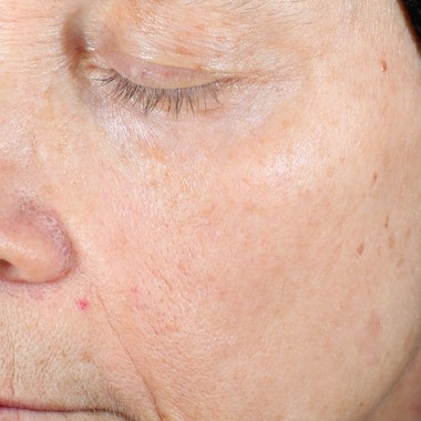 after laser benign pigmentation