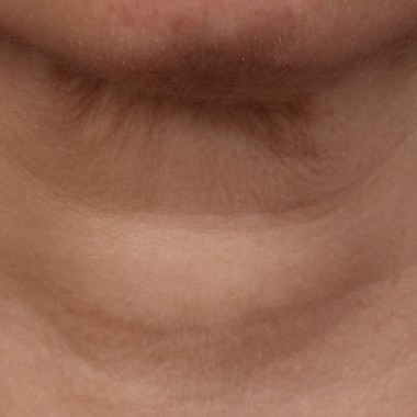 before skinPen