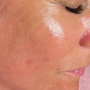 after SkinPen