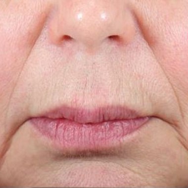 after laser hair removal