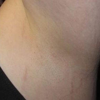 after laser hair removal