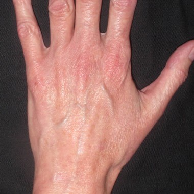after laser skin rejuvenation