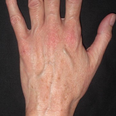 before laser skin rejuvenation