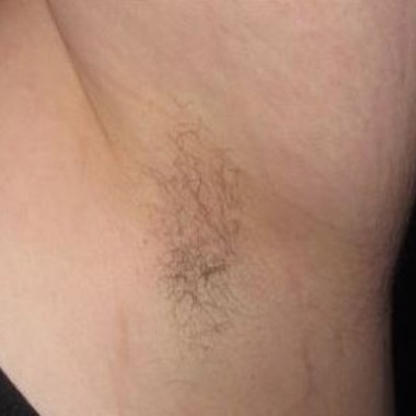 before laser hair removal