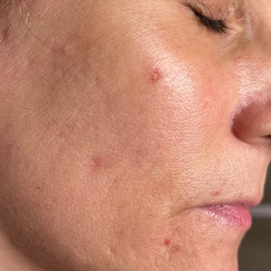 before skinPen