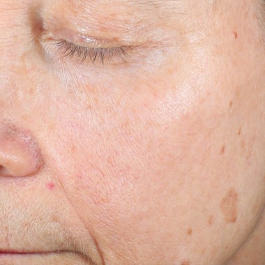 before laser benign pigmentation