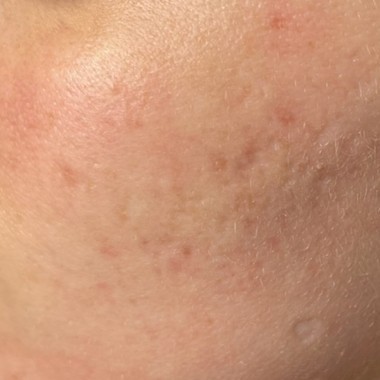 after SkinPen