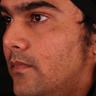 before skinPen
