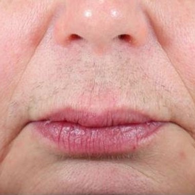 before laser hair removal